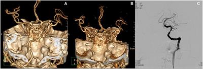 Significance of Vertigo, Imbalance, and Other Minor Symptoms in Hyperacute Treatment of Posterior Circulation Stroke